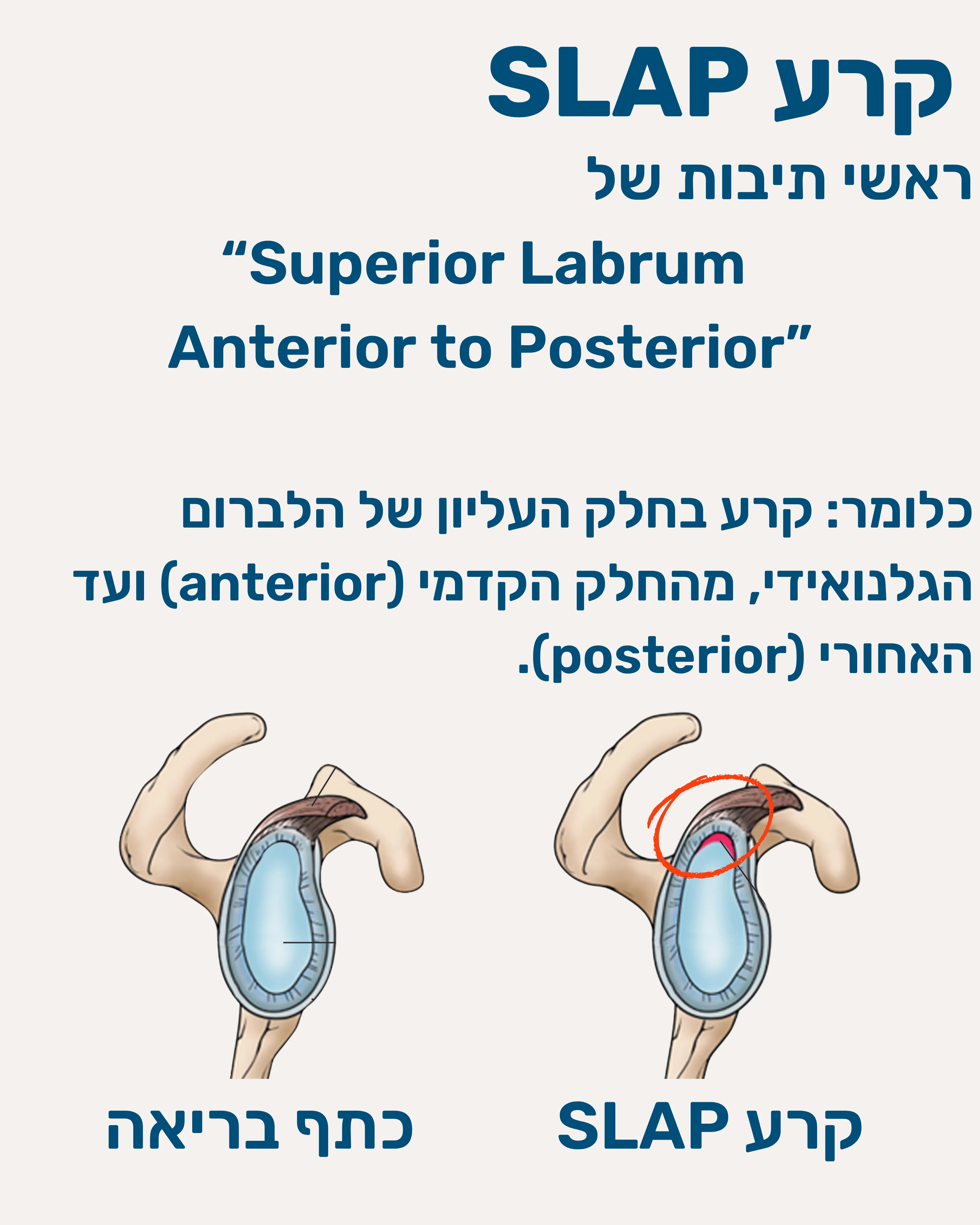 קרע בלברום העליון SLAP - תמונה 4